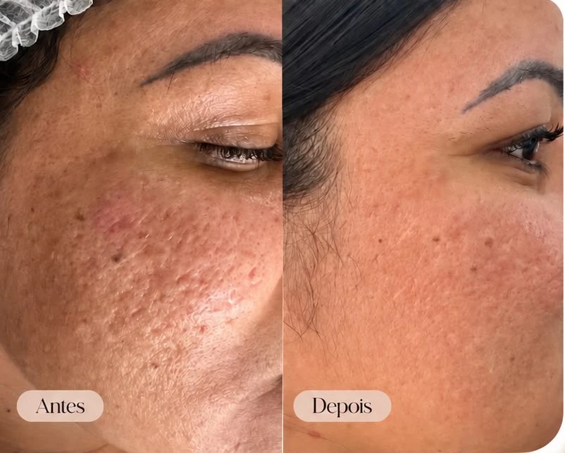 Antes à esquerda e depois à direita de revitalização facial — caso 2