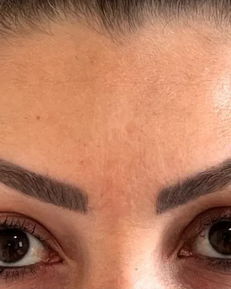 Depois: Registro facial de toxina botulínica