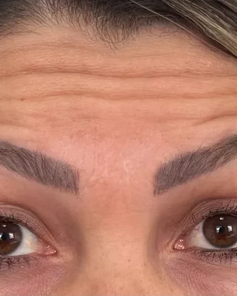 Antes: Registro facial de toxina botulínica