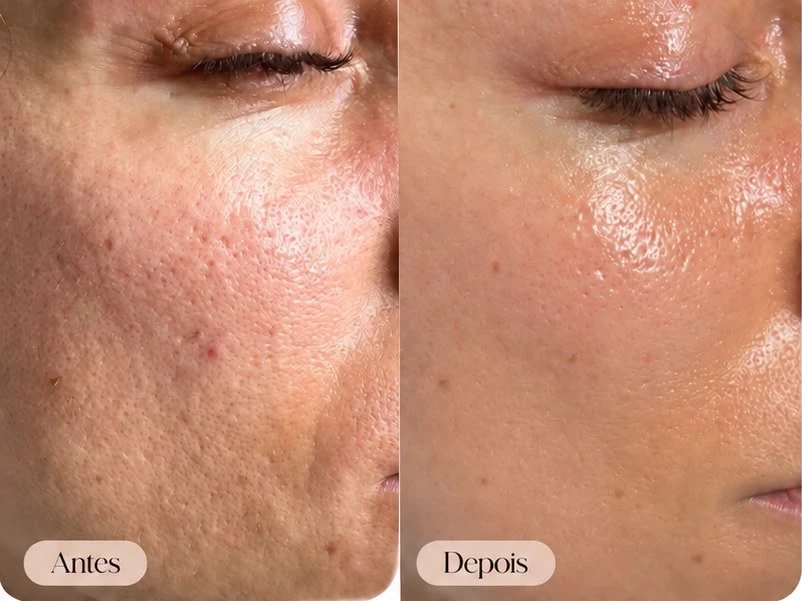 Antes à esquerda e depois à direita de revitalização facial — caso 1
